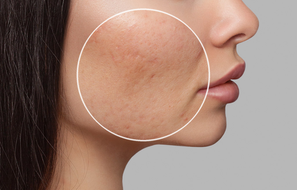 Cicatrici da acne: come trattarle efficacemente con il laser CO2