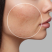 Cicatrici da acne: come trattarle efficacemente con il laser CO2